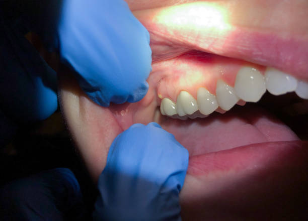 Teeth Whitening in NC